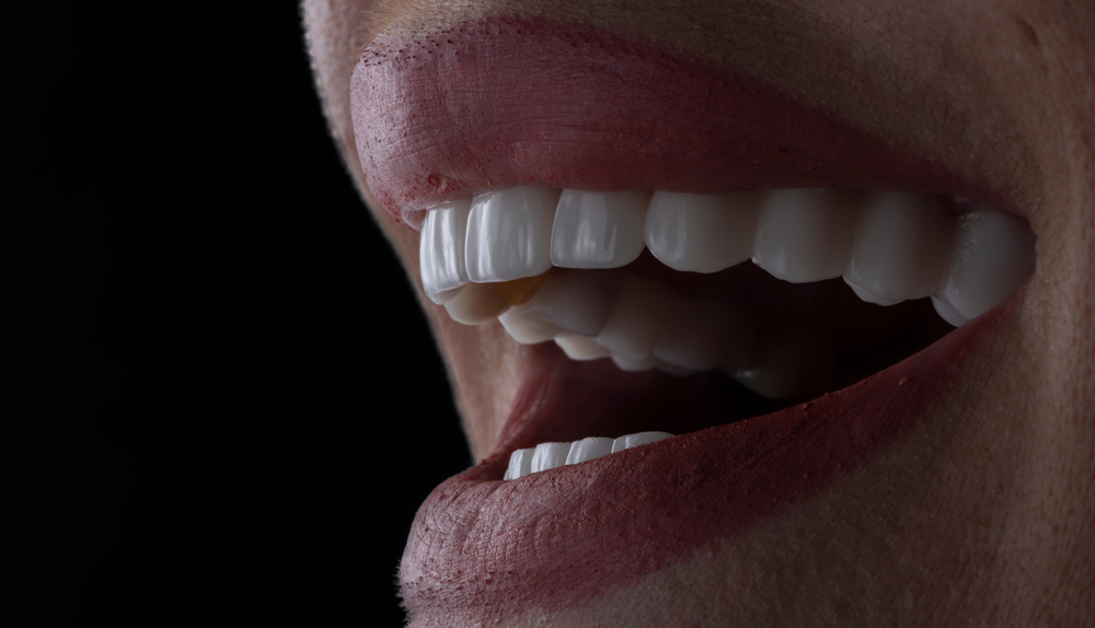 Veneers For A Flawless Smile: What To Expect
