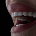 Veneers For A Flawless Smile: What To Expect