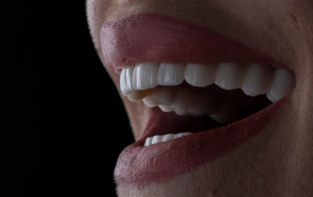 Veneers For A Flawless Smile: What To Expect