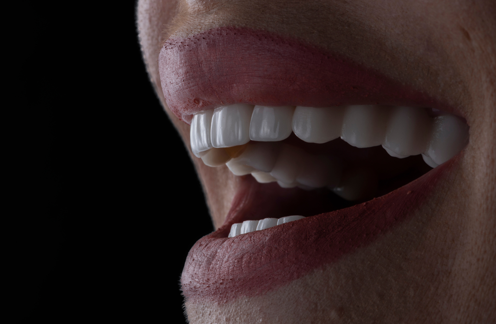 Veneers For A Flawless Smile: What To Expect